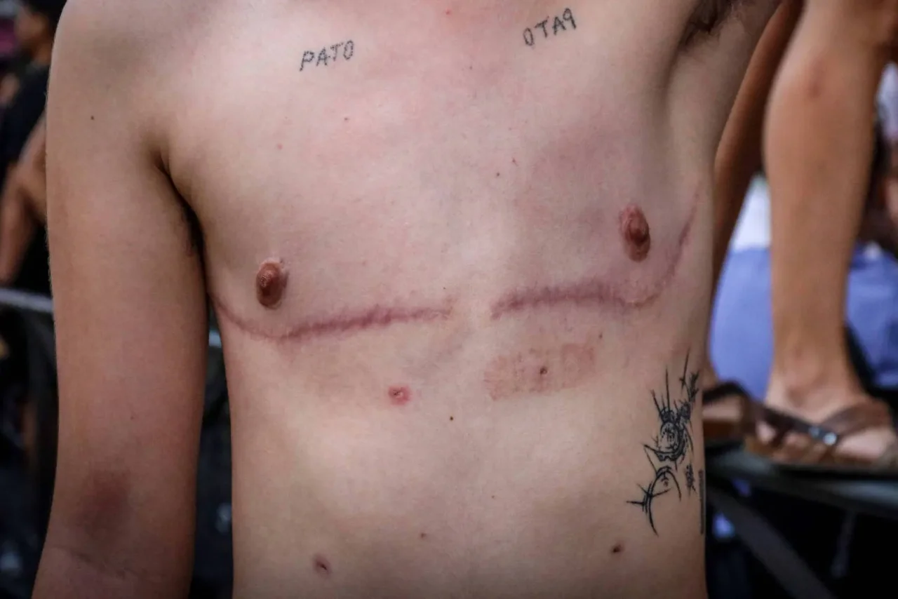 Mediziner in der Schweiz sind von der Praxis der Brustamputation bei minderjährigen Mädchen zunehmend verstört.